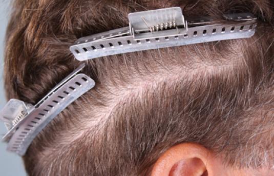 Hair Transplant&nbsp;Trichophytic Donor Scars